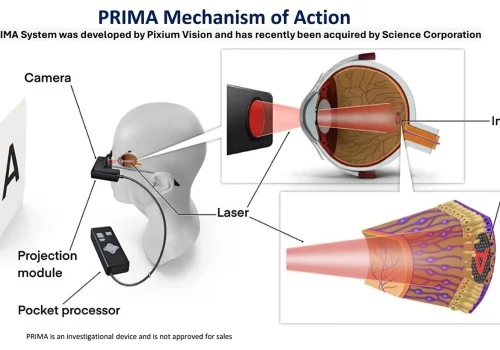 A revolução na DMRI Seca: o implante de retina que está devolvendo a visão e a autonomia a idosos